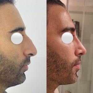 Rinoplasty