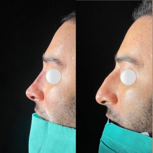 Rinoplasty
