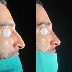 Rinoplasty