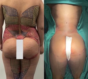 Brazilian Butt Lift