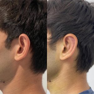 Otoplasty