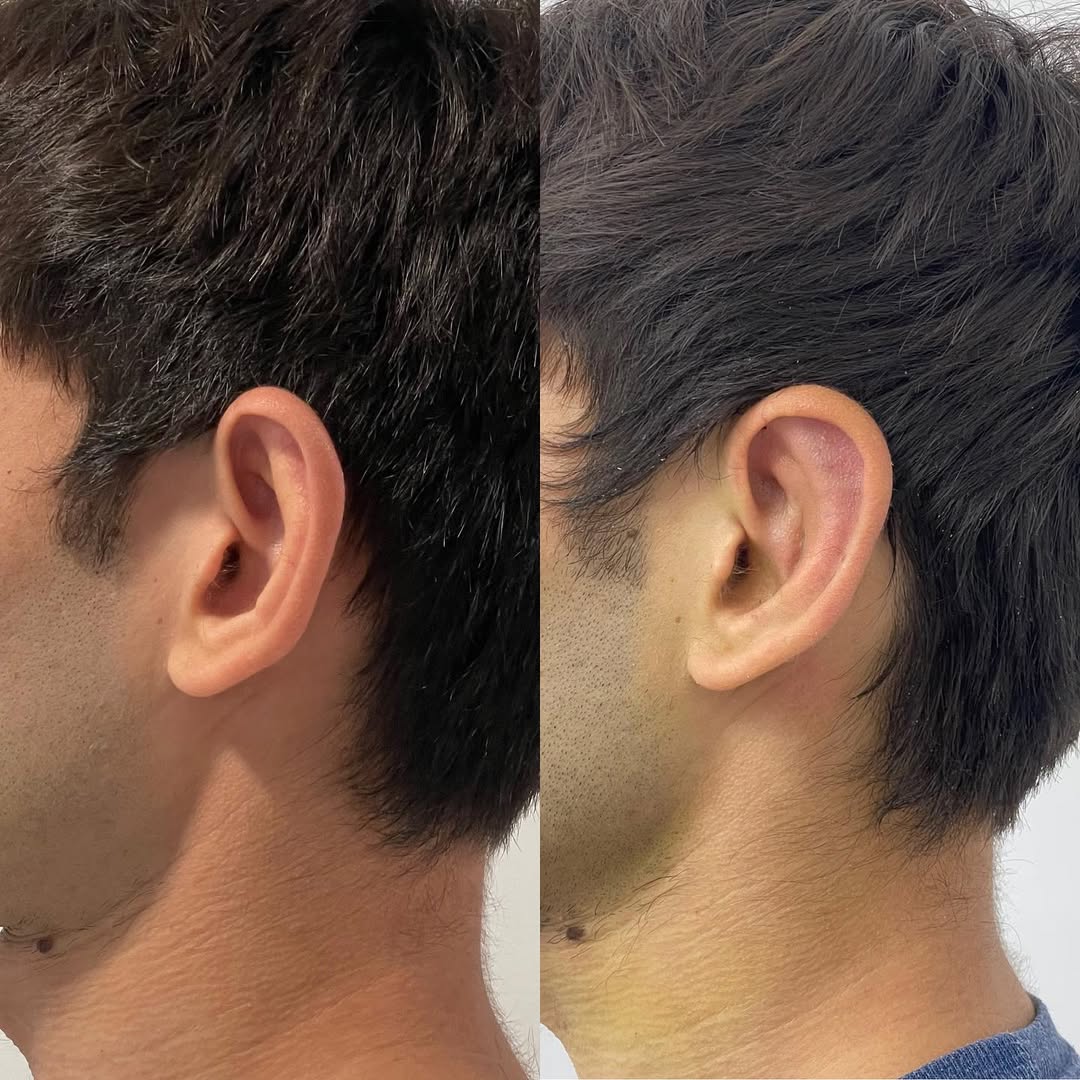 Otoplasty