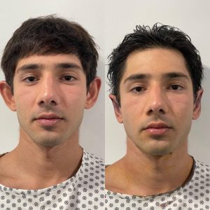 Otoplasty