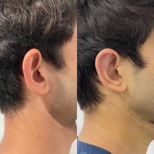 Otoplasty