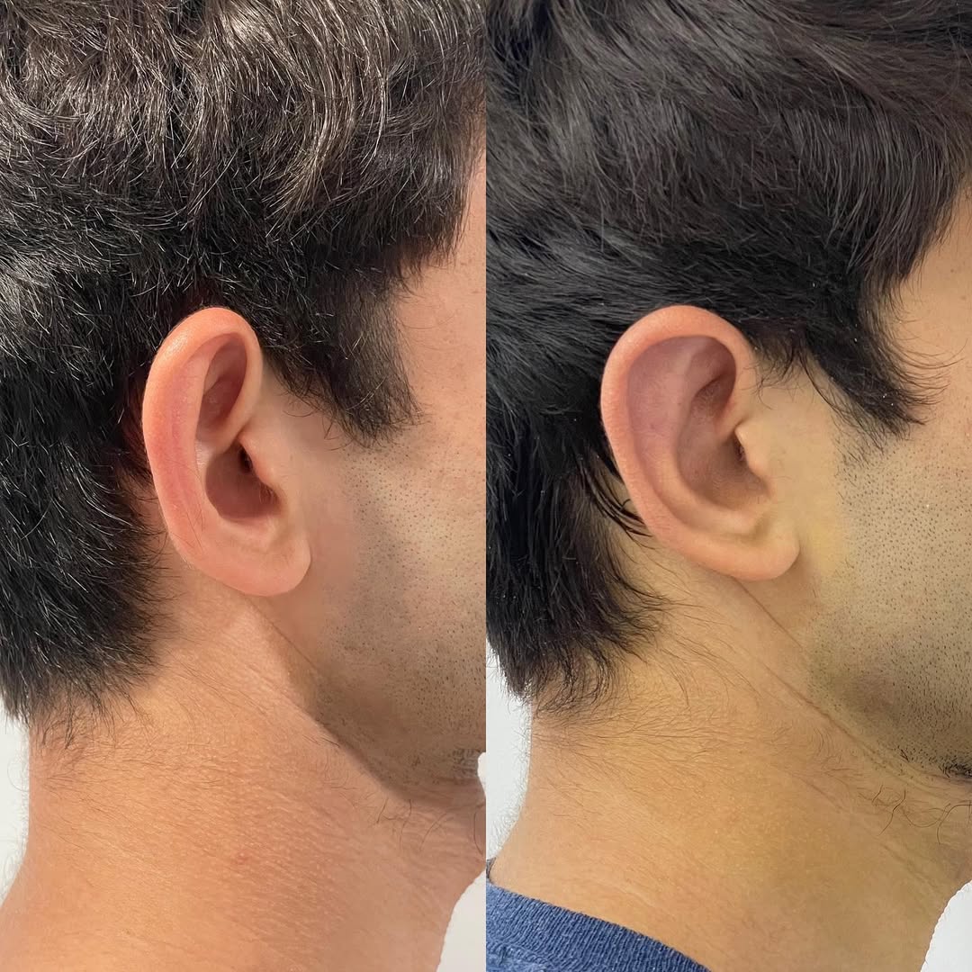 Otoplasty