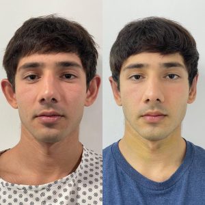 Otoplasty