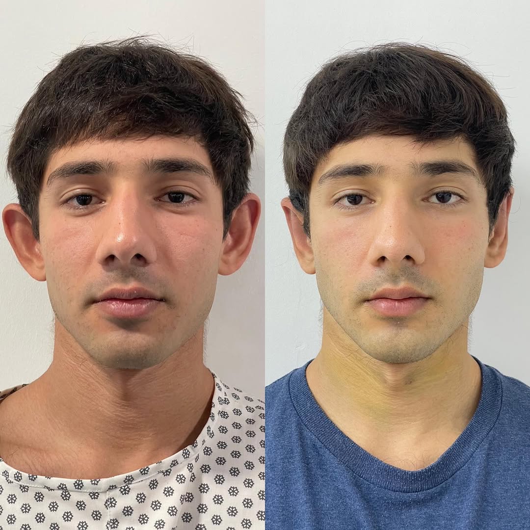 Otoplasty