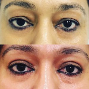 EyeFiller