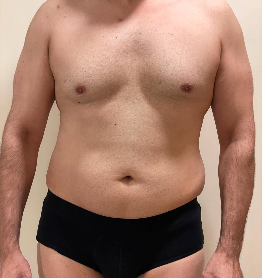 Liposculpture