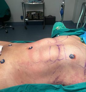 Liposculpture