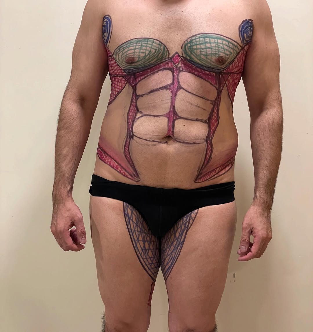 Liposculpture