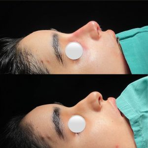 RinoPlasty