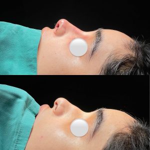 RinoPlasty