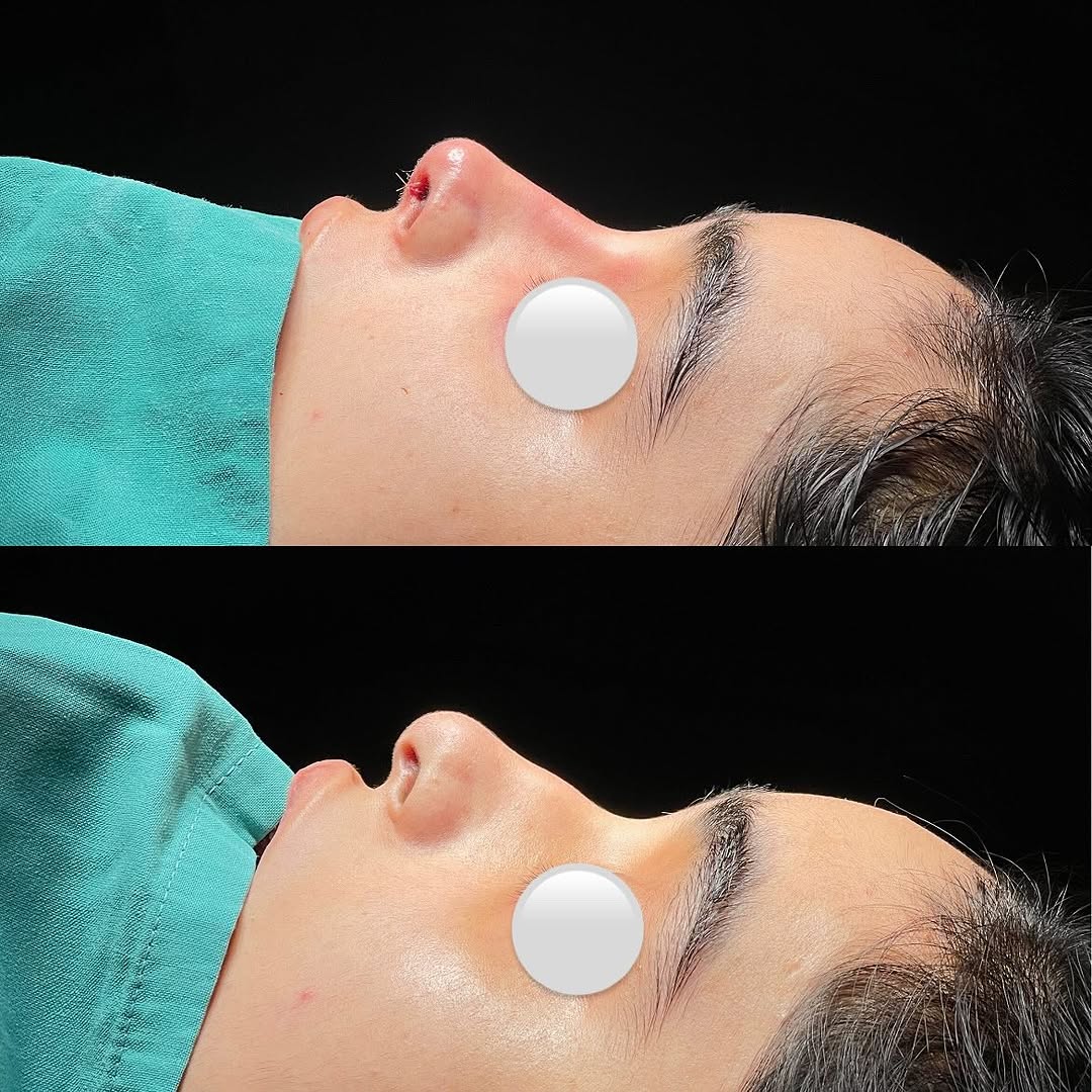 RinoPlasty