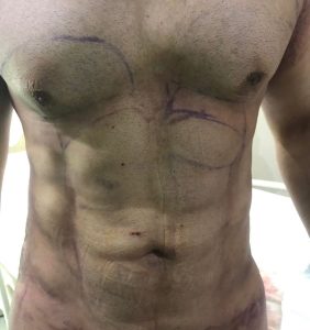 Liposculpture