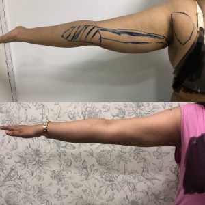 Arm Lift surgery