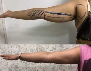 Arm Lift surgery