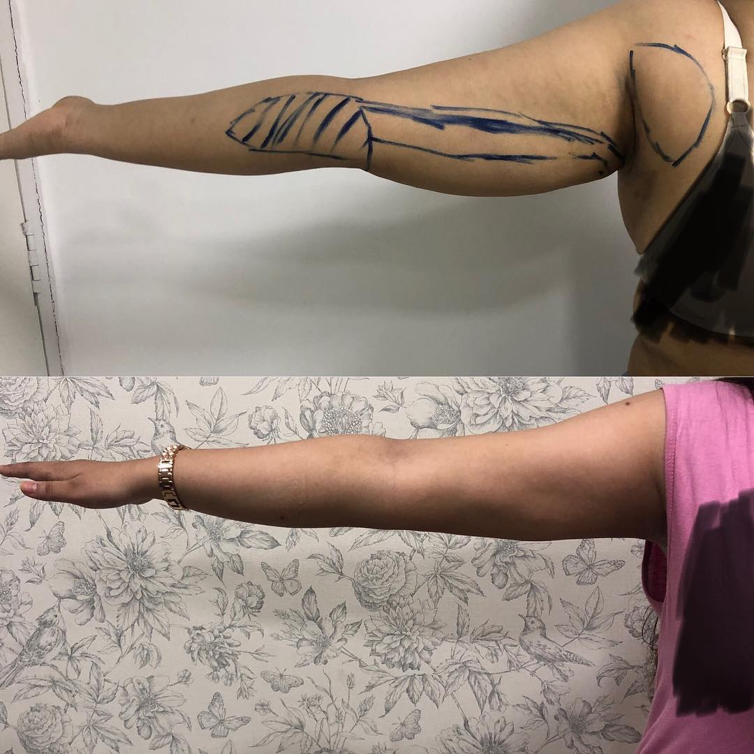 Arm Lift surgery