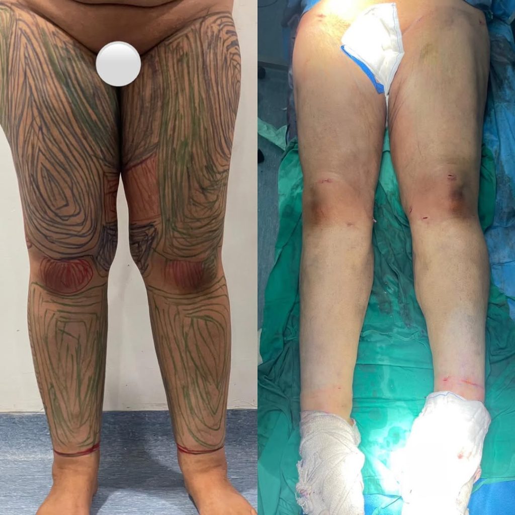 Liposculpture