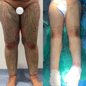 Liposculpture