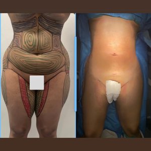 Liposculpture