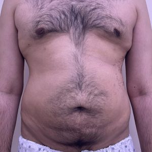 Liposculpture