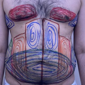 Liposculpture