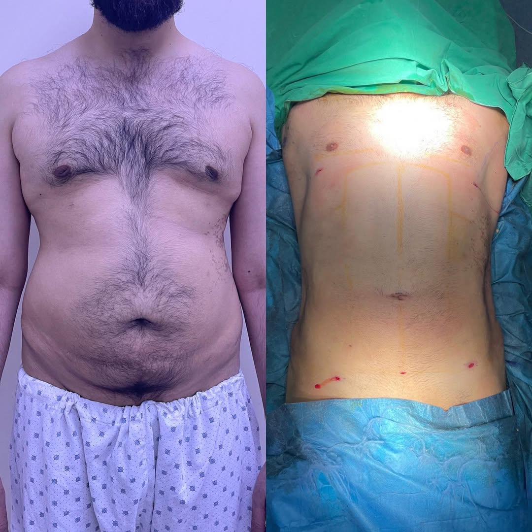 Liposculpture