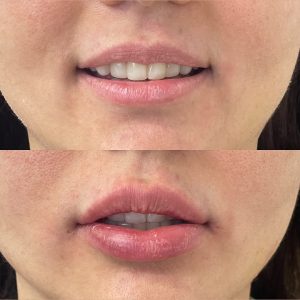 lipFiller