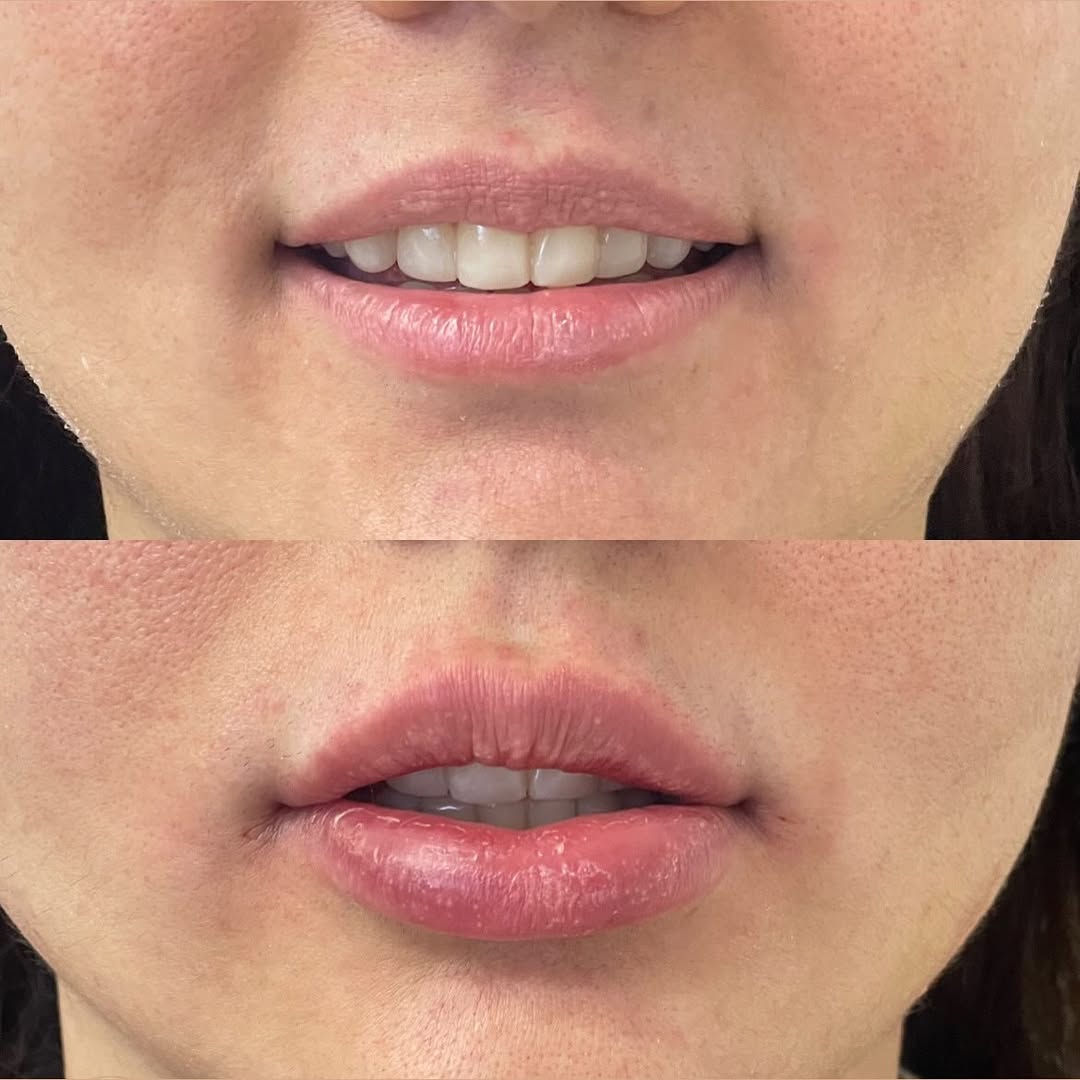 lipFiller