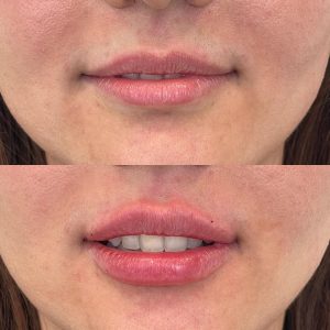 LipFiller