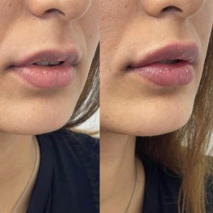 LipFiller