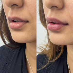 Lip Filler