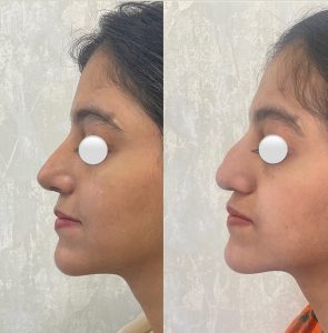 Rinoplasty