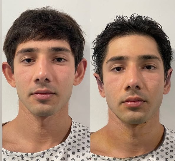 Otoplasty