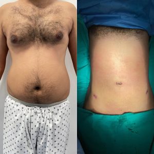 LipoSculpture