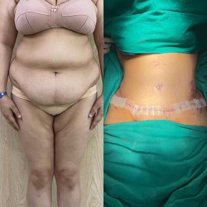 Body Contouring