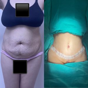 Body Conturing