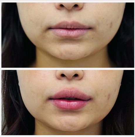 LipFiller